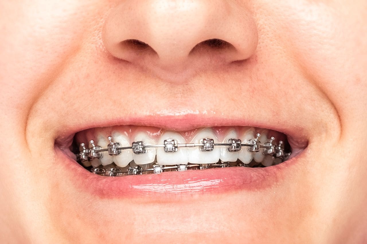 Orthodontics in Buckhannon, WV